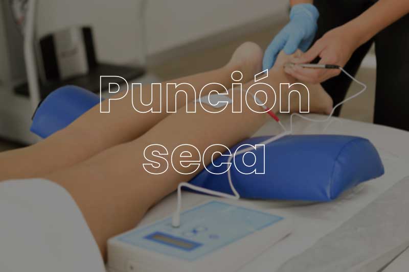 Punción-seca-fisioterapia